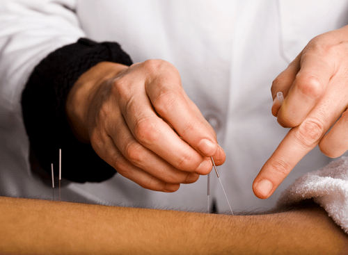 Acupuncturist inserting a needle to his client